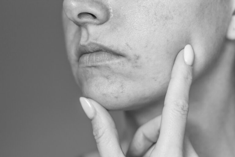 Inflammatory skin disorders – Acne, Perioral Dermatitis and Rosacea
