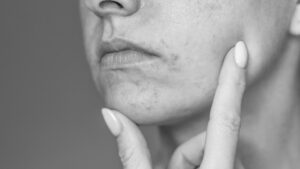 Inflammatory skin disorders - Acne, Perioral Dermatitis and Rosacea