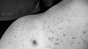 The science of skin cancer – Recognition, risk, and prevention