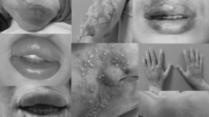 Filler Complications: Mechanisms, Recognition & Safe Clinical Response - Dr. Tom Decates